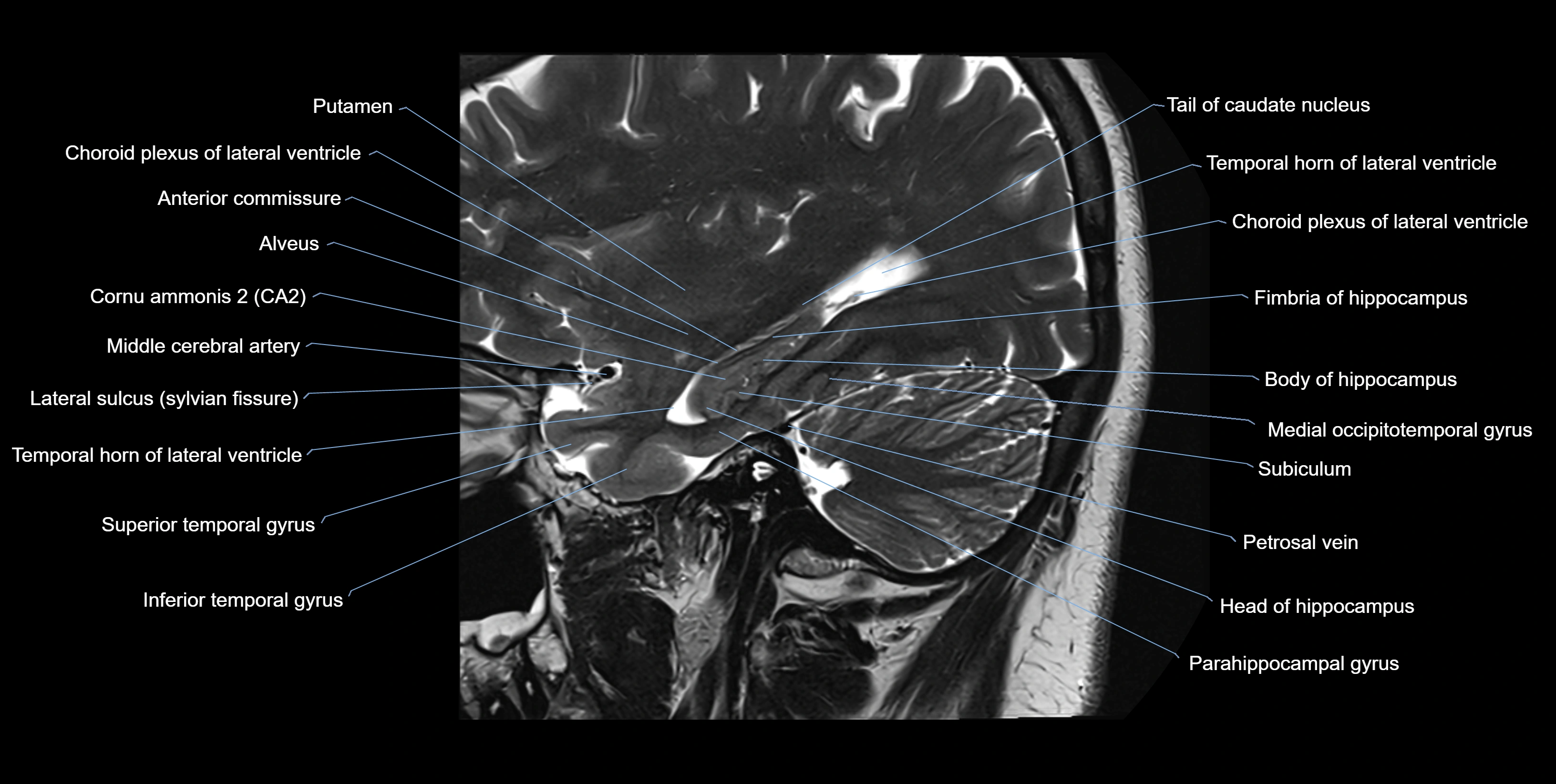 hippocampus sagittal cross sectional anatomy 3T MRI images -img-10004.webp
